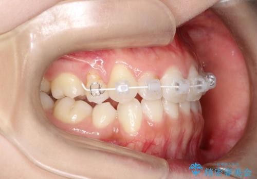 前歯の後戻りを部分矯正で整った歯並びへの治療中