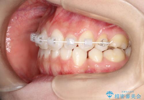 前歯の後戻りを部分矯正で整った歯並びへの治療中