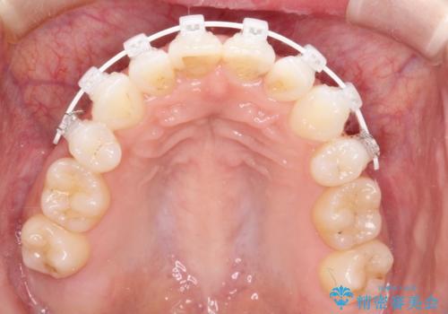 前歯の後戻りを部分矯正で整った歯並びへの治療中