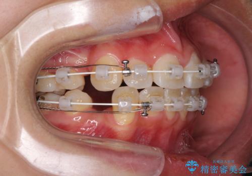 どんなに磨いても汚れが溜まる　抜歯矯正で清潔な口元にの治療中