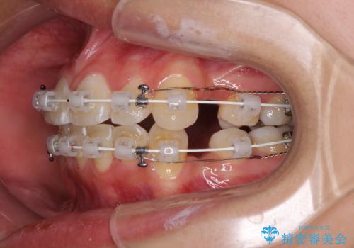 どんなに磨いても汚れが溜まる　抜歯矯正で清潔な口元にの治療中