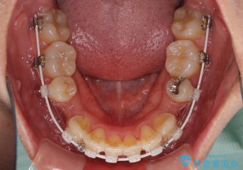どんなに磨いても汚れが溜まる　抜歯矯正で清潔な口元にの治療中