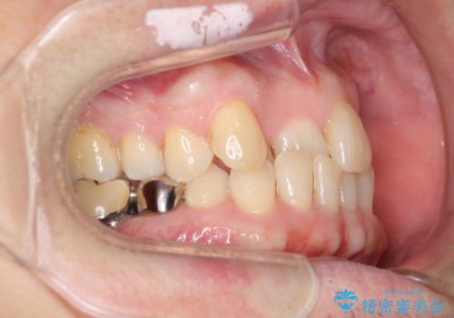 50代男性 受け口 他院で5年以上かかると治療を断られたの治療前