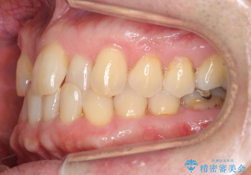 50代男性 受け口 他院で5年以上かかると治療を断られたの治療前