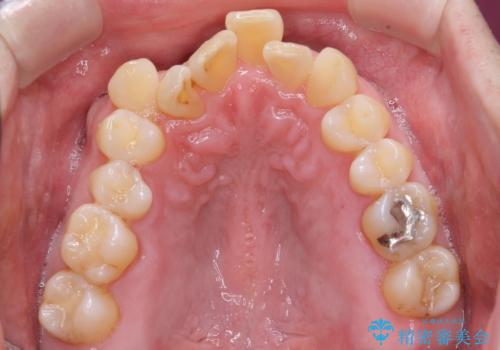 50代男性 受け口 他院で5年以上かかると治療を断られたの治療前