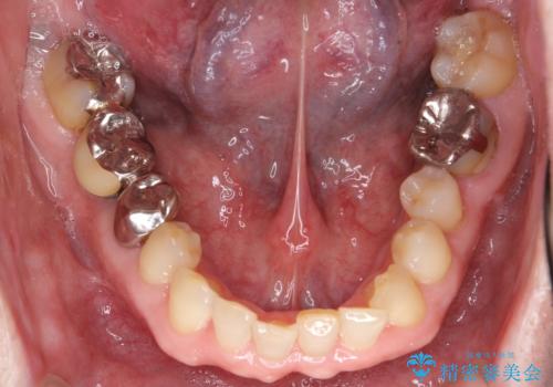50代男性 受け口 他院で5年以上かかると治療を断られたの治療前
