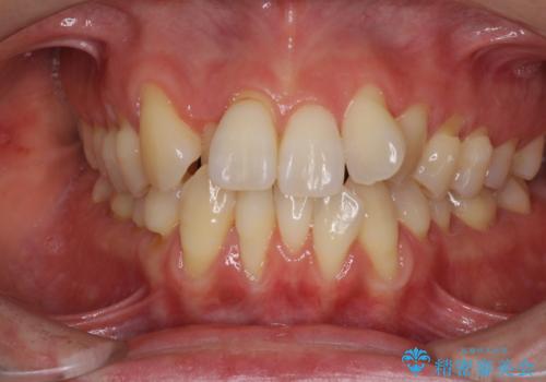 前歯のデコボコを治したい 費用を抑えた抜歯矯正の症例 治療前