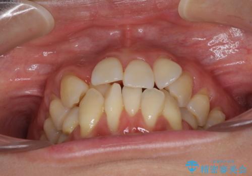 前歯のデコボコを治したい 費用を抑えた抜歯矯正の治療前