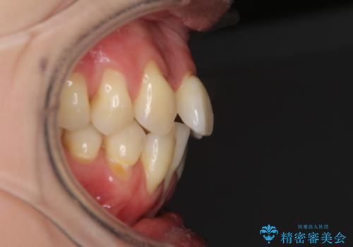 前歯のデコボコを治したい 費用を抑えた抜歯矯正の治療前