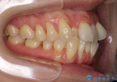 前歯のデコボコを治したい 費用を抑えた抜歯矯正の治療前