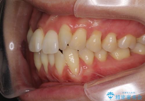 前歯のデコボコを治したい 費用を抑えた抜歯矯正の治療前