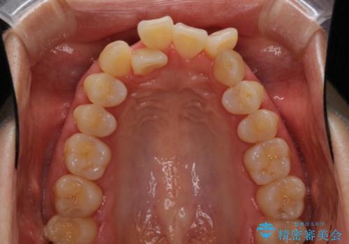 前歯のデコボコを治したい 費用を抑えた抜歯矯正の治療前