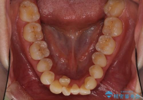 前歯のデコボコを治したい 費用を抑えた抜歯矯正の治療前
