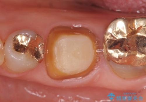 オールセラミッククラウン 他院にて抜歯と言われた歯の治療の治療中