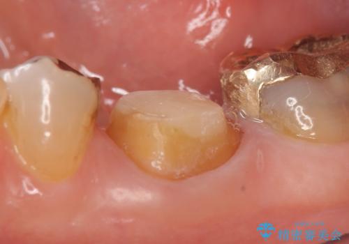 オールセラミッククラウン 他院にて抜歯と言われた歯の治療の治療中