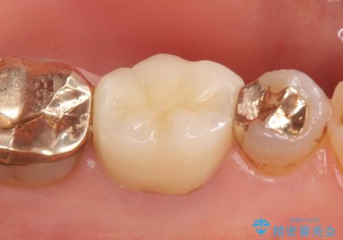 オールセラミッククラウン 他院にて抜歯と言われた歯の治療の治療後