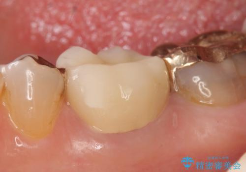 オールセラミッククラウン 他院にて抜歯と言われた歯の治療の治療後