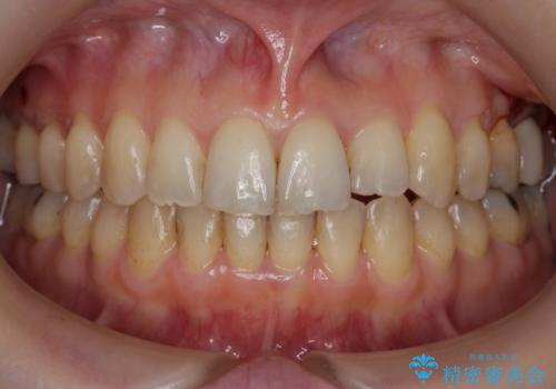 前歯のガタガタ　治療期間がかかっても良いので非抜歯でマウスピースでの症例 治療後