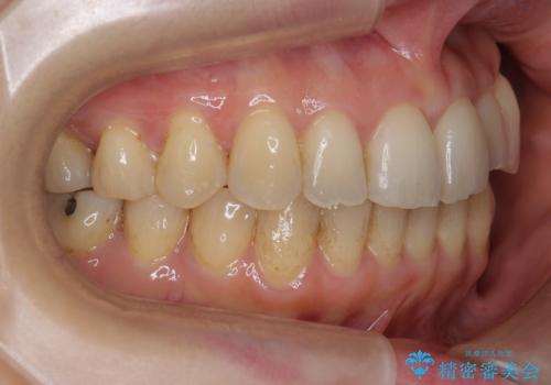 前歯のガタガタ　治療期間がかかっても良いので非抜歯でマウスピースでの治療後