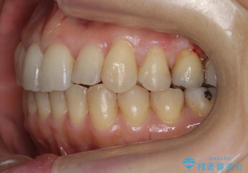 前歯のガタガタ 治療期間がかかっても良いので非抜歯でマウスピースでの治療後