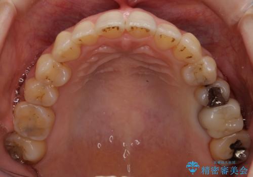 前歯のガタガタ　治療期間がかかっても良いので非抜歯でマウスピースでの治療後