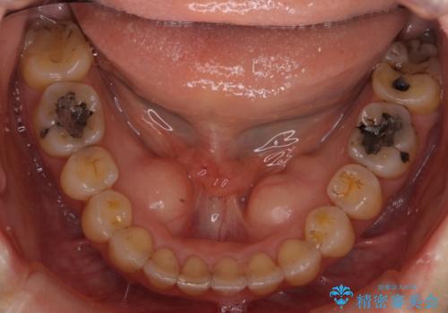 前歯のガタガタ 治療期間がかかっても良いので非抜歯でマウスピースでの治療後