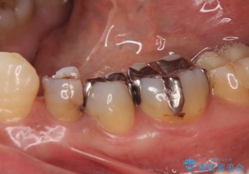 オールセラミッククラウン 奥歯の銀歯を白くの治療前