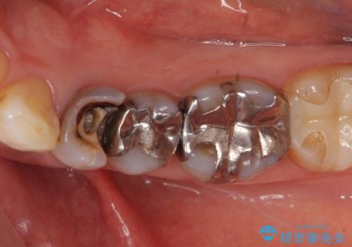 オールセラミッククラウン 奥歯の銀歯を白くの症例 治療前
