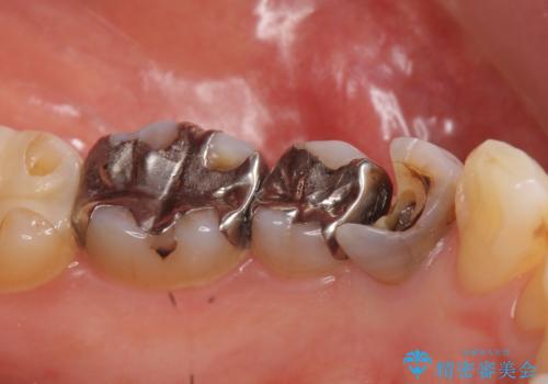 オールセラミッククラウン 奥歯の銀歯を白くの治療前