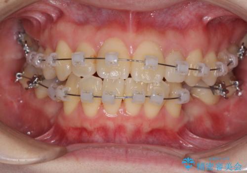 話しにくい歯並びの改善 抜歯矯正治療と前歯の審美治療の治療中