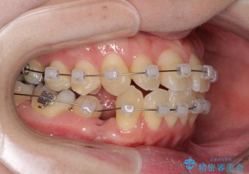 話しにくい歯並びの改善 抜歯矯正治療と前歯の審美治療の治療中
