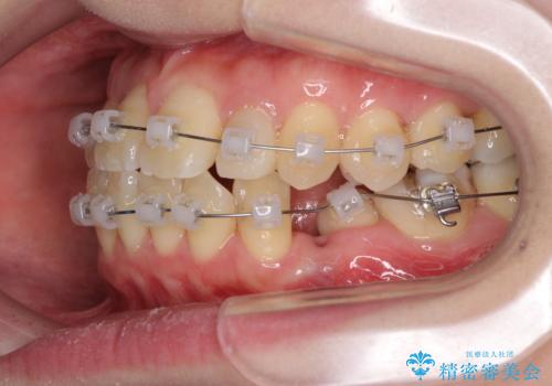 話しにくい歯並びの改善　抜歯矯正治療と前歯の審美治療の治療中