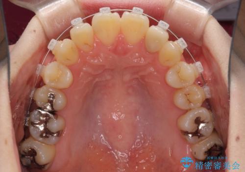 話しにくい歯並びの改善 抜歯矯正治療と前歯の審美治療の治療中