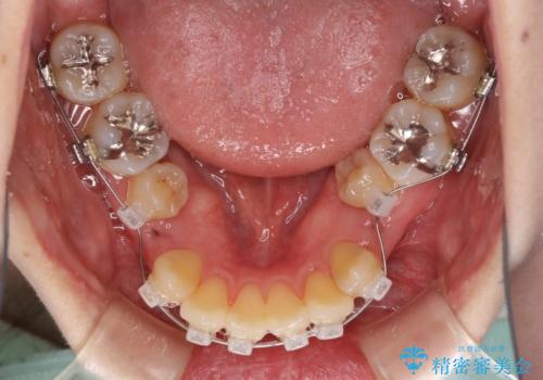 話しにくい歯並びの改善 抜歯矯正治療と前歯の審美治療の治療中