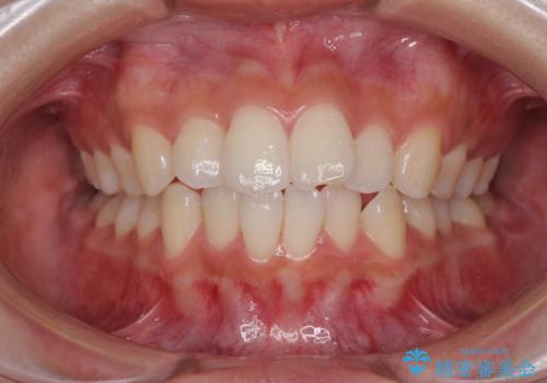 前歯のデコボコと突出感　インビザラインで改善の症例 治療前