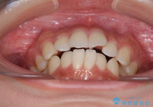 前歯のデコボコと突出感 インビザラインで改善の治療前