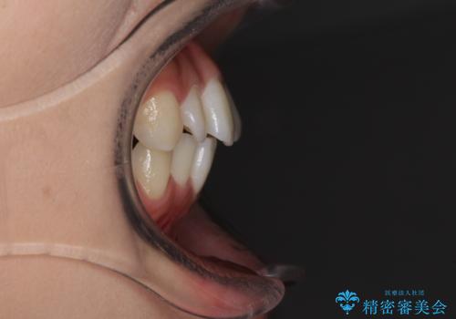 前歯のデコボコと突出感 インビザラインで改善の治療前