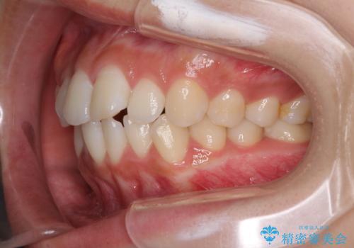 前歯のデコボコと突出感 インビザラインで改善の治療前