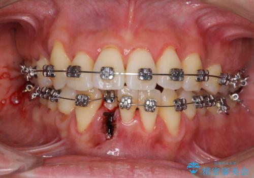 前歯のデコボコを治したい 費用を抑えた抜歯矯正の治療中