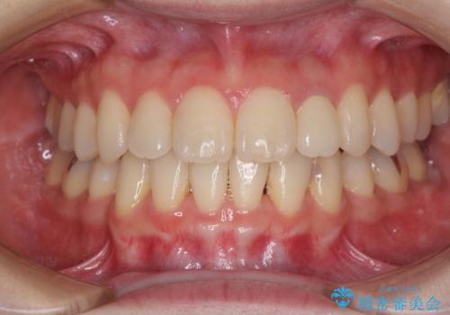 話しにくい歯並びの改善　抜歯矯正治療と前歯の審美治療の治療後