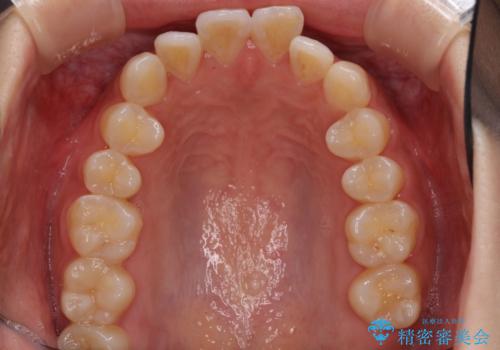 前歯のデコボコと突出感 インビザラインで改善の治療前