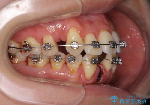 前歯のデコボコを治したい 費用を抑えた抜歯矯正の治療中