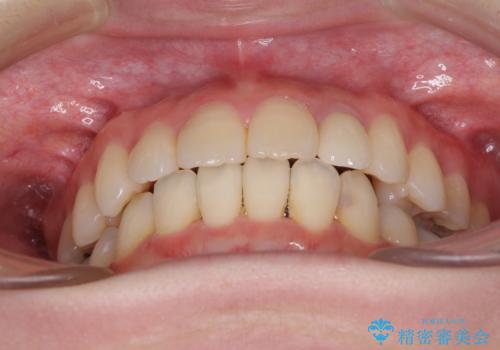 話しにくい歯並びの改善 抜歯矯正治療と前歯の審美治療の治療後