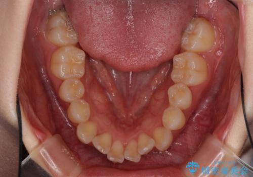 前歯のデコボコと突出感　インビザラインで改善の治療前