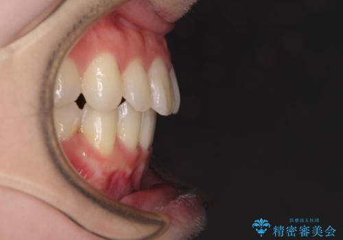 話しにくい歯並びの改善 抜歯矯正治療と前歯の審美治療の治療後