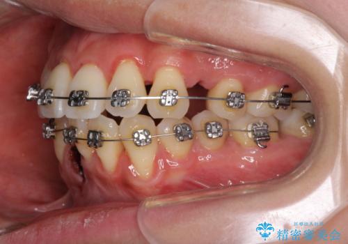 前歯のデコボコを治したい 費用を抑えた抜歯矯正の治療中