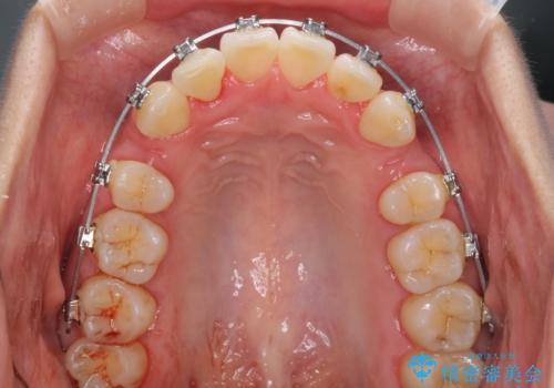 前歯のデコボコを治したい 費用を抑えた抜歯矯正の治療中