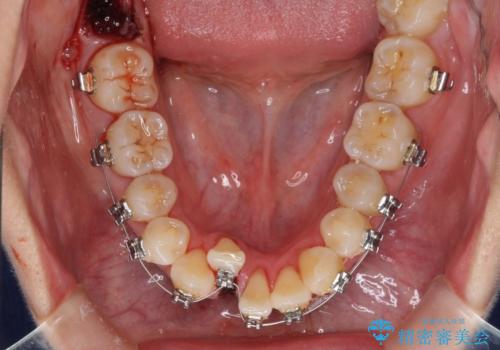 前歯のデコボコを治したい 費用を抑えた抜歯矯正の治療中