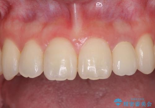 話しにくい歯並びの改善　抜歯矯正治療と前歯の審美治療