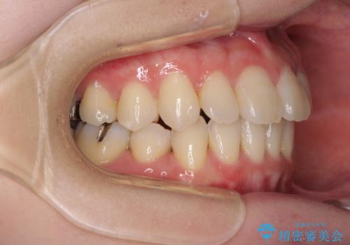 話しにくい歯並びの改善 抜歯矯正治療と前歯の審美治療の治療後